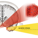 Illustration for article titled Obat Stroke Alternatifem/em